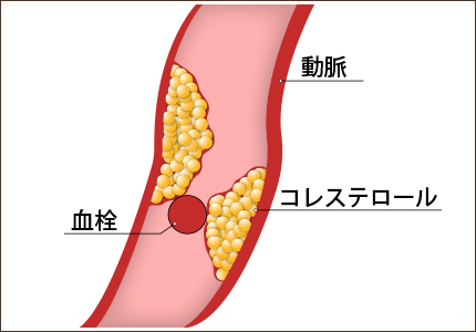 血管の目詰まり