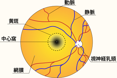 黄斑変性症